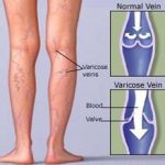 6) Is Rebounding Bad for Varicose Veins?